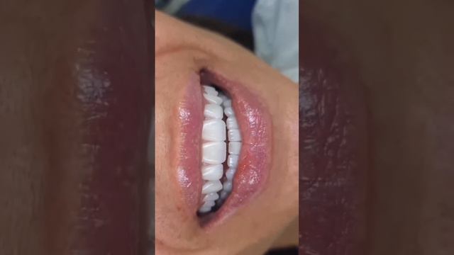 Full mouth rehabilitation crowns and bridges done with hight translucent zirconia#satisfying #viral