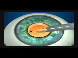 Факоэмульсификация катаракты