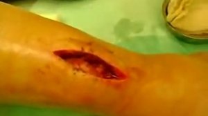 Перевязка раны голени