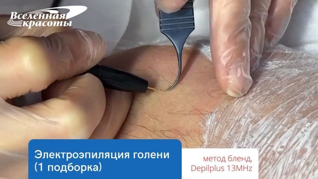 Электроэпиляция голени методом blend смотреть онлайн