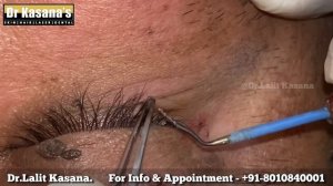 Wart & Skin Tag Removal Around Eyes by Dr.Lalit Kasana