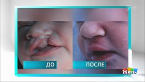 Клиническая картина. Заячья губа. Жить здорово! Фрагмент выпуска от 29.10.2020