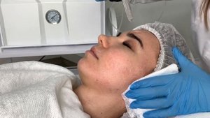 Манипула Газожидкостный пилинг АтисМед