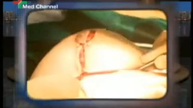 Уменьшение груди. Нодас Капоситас смотреть онлайн