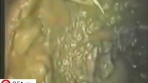 Колоноскопия толстой кишки изнутри