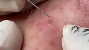 Каждый день залипательное видео Выдавливание черных точек прыщей x2