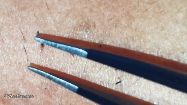 Ingrown hair + thick facial hair extraction смотреть онлайн