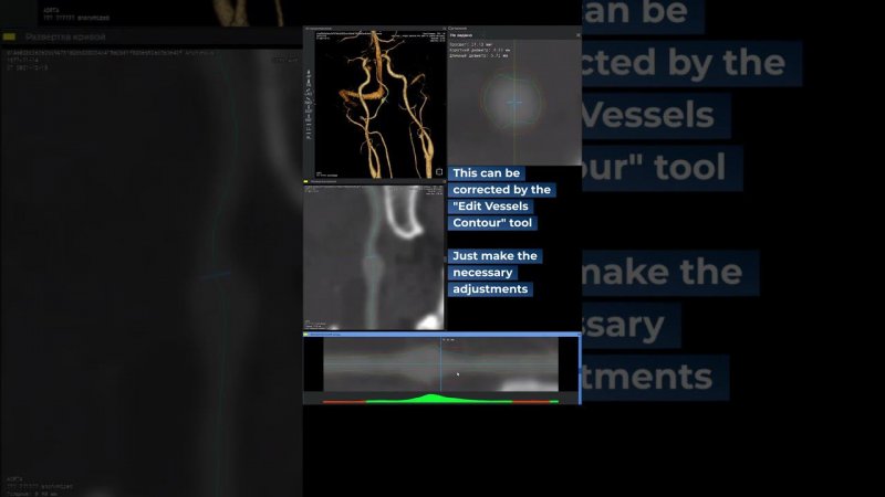 Let's analyze it. Fusiform aneurysm