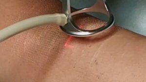 Лазерная шлифовка шрамов фракционным СО2 лазером в Оренбурге