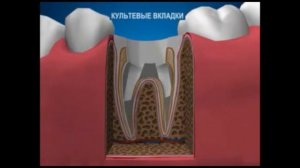 Что такое культевая вкладка