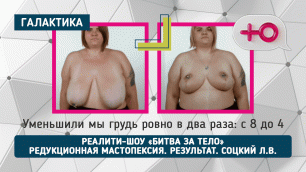 Реалити-шоу "Битва за тело": Операция по уменьшению груди - результат | Лев Соцкий
