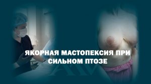 Якорная подтяжка молочных желез