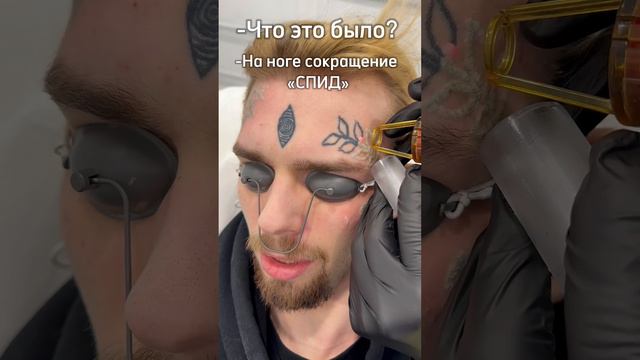 Лазерное удаление татуировки
