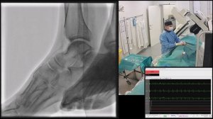 Восстановление артерий нижней конечности при синдроме диабетической стопы.