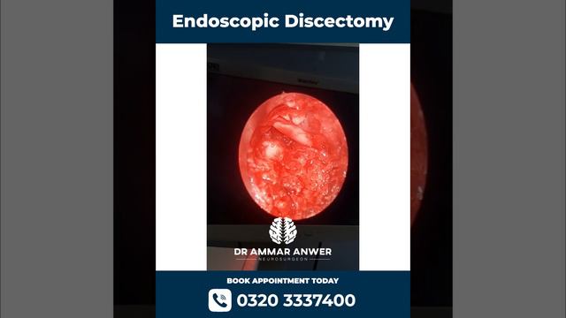 Percutanous Endoscopic disc Surgery | Endoscopic Discectomy | Neurosurgeon Dr Ammar Anwer