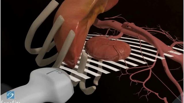 3D-пособие: Ультразвуковое исследование правой почки -- ультразвуковая система SonoSite