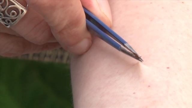 How to properly remove a tick смотреть онлайн