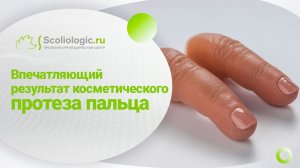Косметический протез пальца. Не отличить!