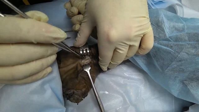 Синдром карпального канала.Открытая декомпрессия срединного нерва.
