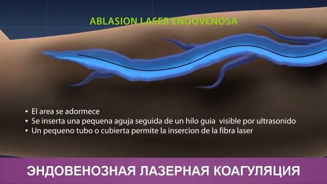 Эндовенозная лазерная коагуляция