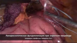 Лапароскопическая фундопликация при фиксированной ГПОД, вторично укороченном пищеводе
