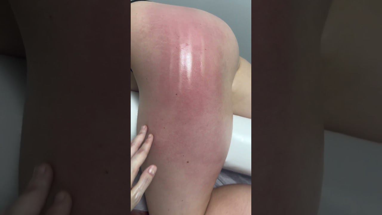 Ручная липосакция зоны галифе #youtubeshorts #shortvideo #massage #массаж #tiktok #relax #shorts