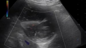 О калькулезный холецистит  Эмпиема желчного пузыря