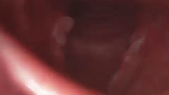 Двухсторонняя гранулема | www.wohlt.ru смотреть онлайн