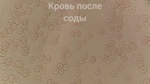 Кровь после приема соды. Состояние эритроцитов до и после.