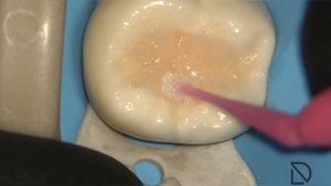 Direct restoration of the second lower molar. Прямая реставрация второго нижнего моляра