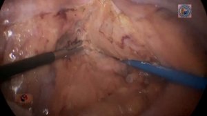 Laparoscopic (APR) abdominoperineal resection/Лап. брюшно-промежностная экстирпация прямой кишки