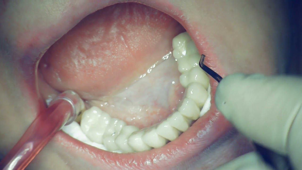 Fixation of a metal-ceramic prosthesis on 4 implants. ICX-multi. All-on-4.