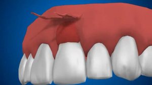 пластика десны