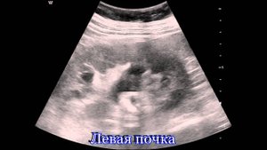 Нефростома