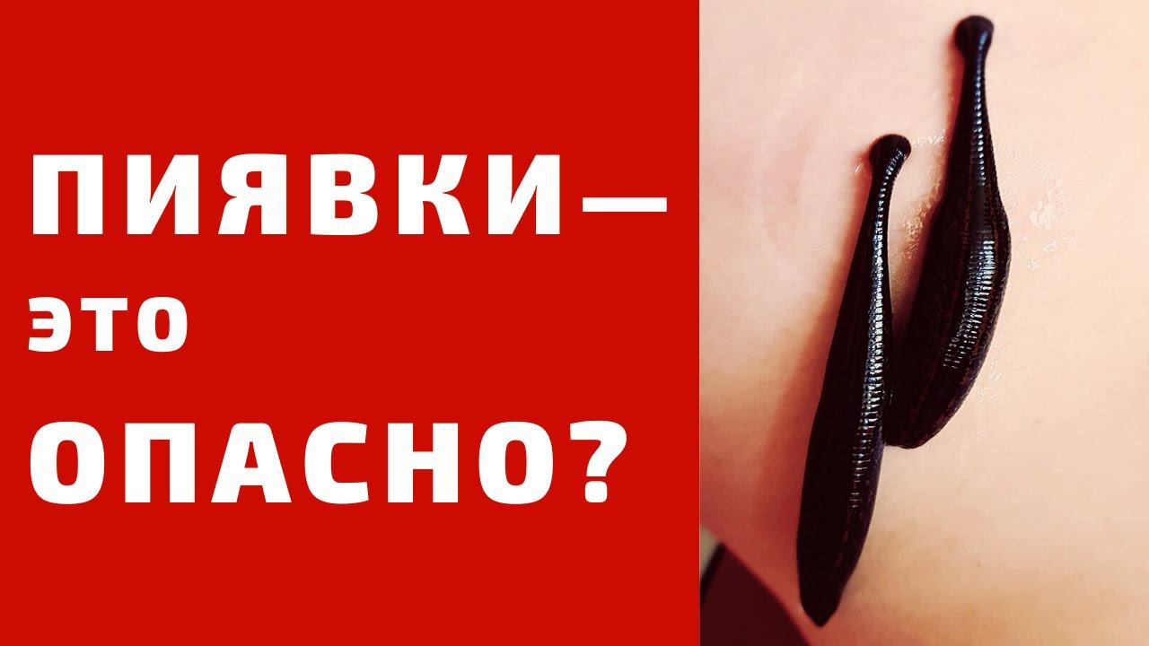 Осложнения гирудотерапии. Опасны ли пиявки?
