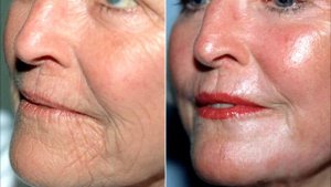 Салициловый пилинг