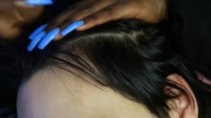 ASMR | AllZoomed Scalp Scratching with nails | Picking Whiteheads | Blowing & Brushing away