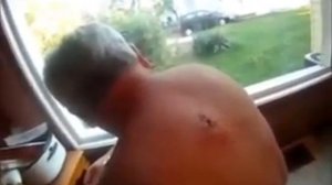 Самый большой прыщ в мире