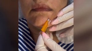 Мезо Нити "Фирмоза" результаты до  после . @cosmetology_qtu