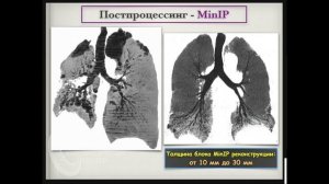 Методика проведения КТ легких, рекомендации по анализу изображений. Андрей Мангов. Часть 2