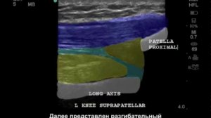 Kоленный сустав — тендинит сухожилия четырехглавой мышцы