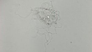 Гемолитический стрептококк (Streptococcus agalactiae) на плоском эпителии