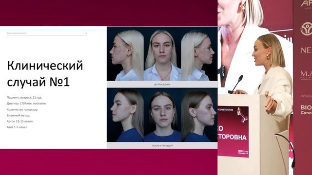 Инновационный метод терапии акне без побочных эффектов за 3 месяца. Плазмотерапия и RF-лифтинг. смотреть онлайн