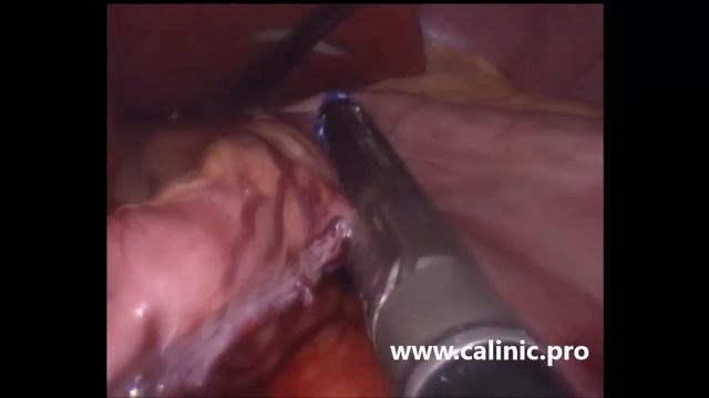 Лапароскопическая продольная резекция желудка