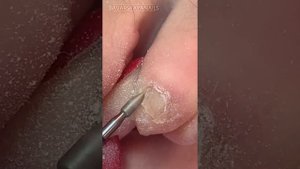 Педикюру 5месяцев.Откапываем мизинец