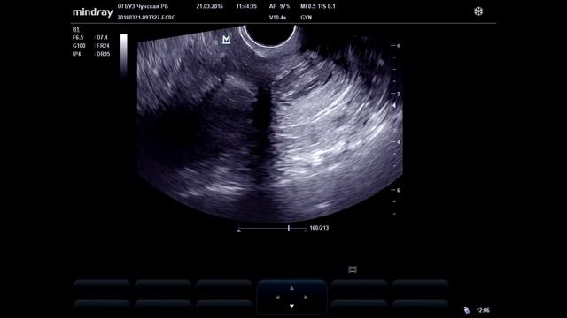 Родившаяся миома смотреть онлайн