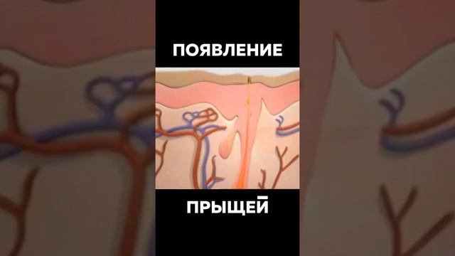 Как Появляются Прыщи ? #Шок #Ого #Прыщи ? Появление Прыщей На Лице у Человека ? Как Избавиться ???