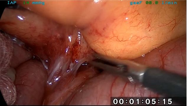 Laparoscopic Management of Early Mechanical Small Bowel Obstruction смотреть онлайн