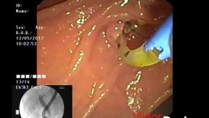 РХПГ (ERCP)