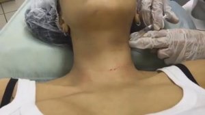 Контурная пластика шеи, избавление от колец венеры в СПб   косметолог Оксана Бойко